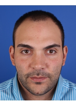 Before Hair Transplant&nbsp;Front